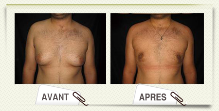 gynecomastie avant apres